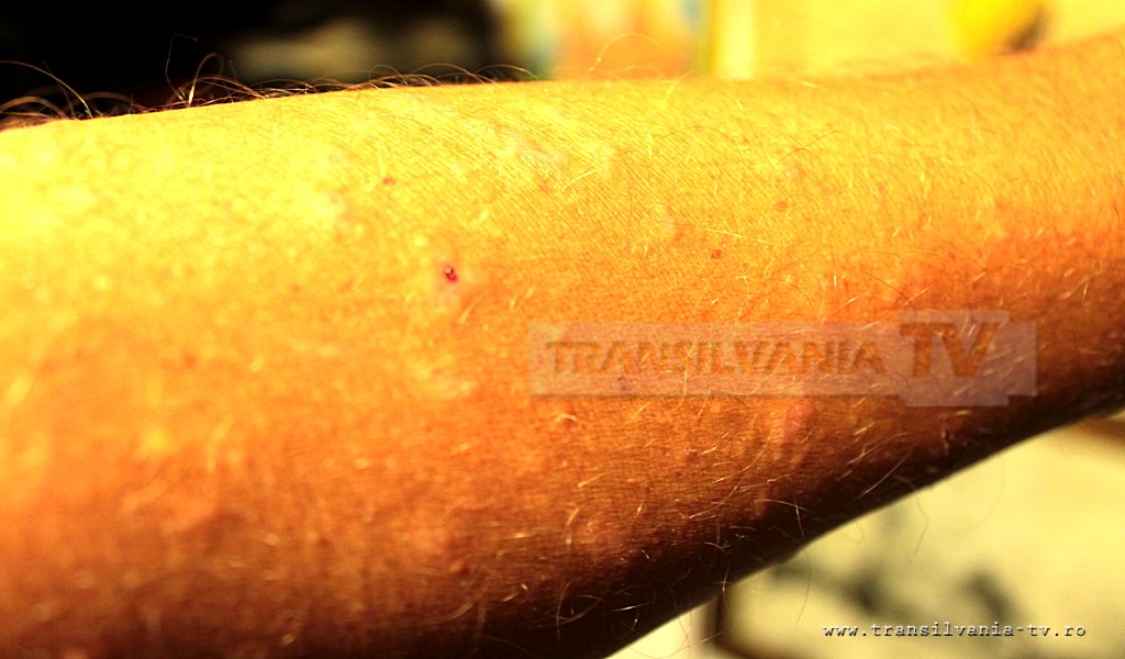Pastila de sanatate – Ce este urticaria si cum poate fi tratata?